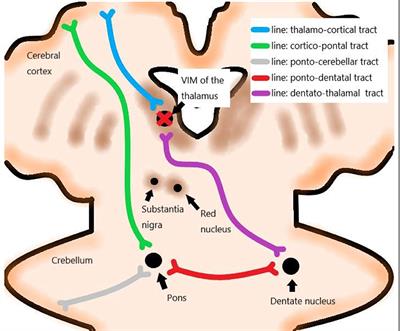 Focused Ultrasound Thalamotomy for the Treatment of Essential Tremor: A 2-Year Outcome Study of Chinese People